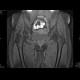 Aseptic necrosis of femoral head: MRI - Magnetic Resonance Imaging